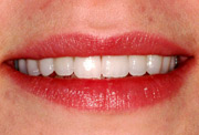 Cosmetic Dentistry | Implant Dentistry | Orange County NY | Port Jervis